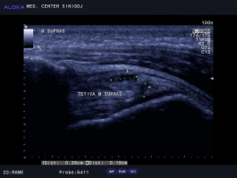 Ultrazvok rame - natrganje tetive m. supraspinatus